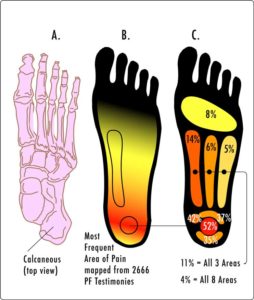 plantar fasciitic pain areas