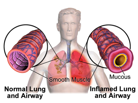 Asthma Explained